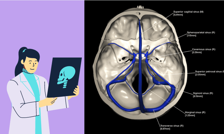 Venous Sinuses of Brain