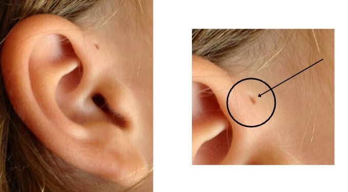 Preauricular Sinus Surgery Cost
