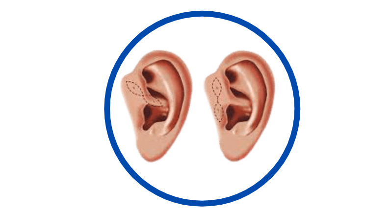 Preauricular Sinus Surgery Cost