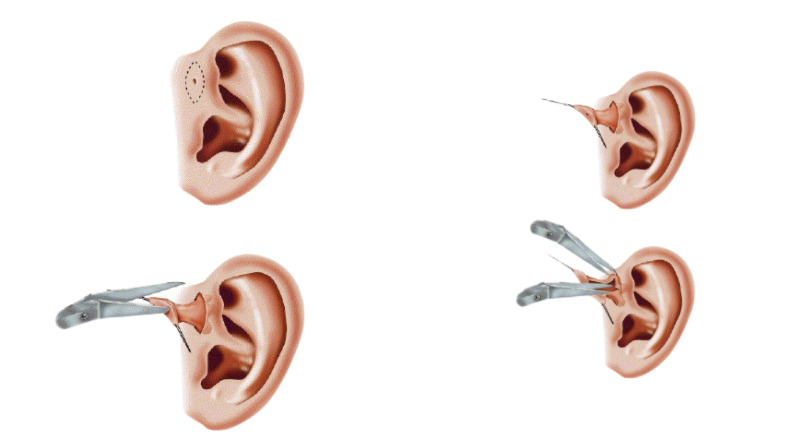 Preauricular Sinus Surgery Cost