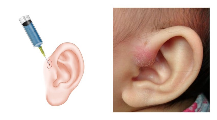 Preauricular Sinus Surgery Cost