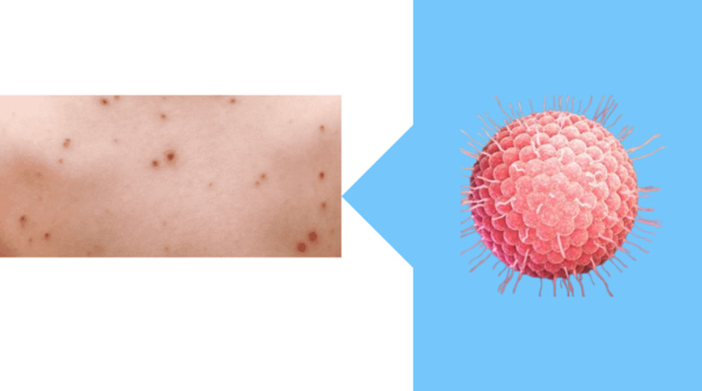 chickenpox vaccine side effects toddler