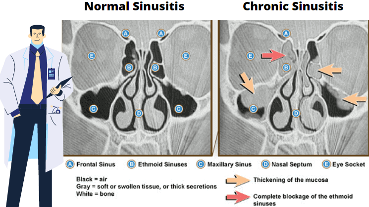 chronic sinusitis ct scan