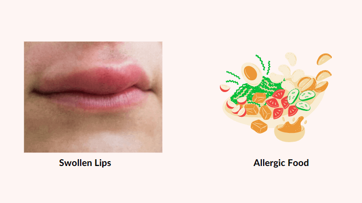 swollen lips allergy food