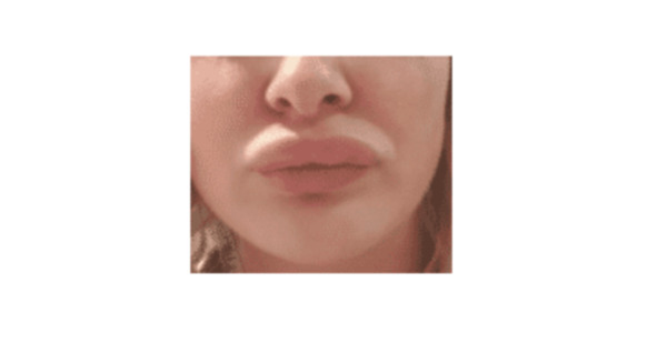 swollen lips allergy food