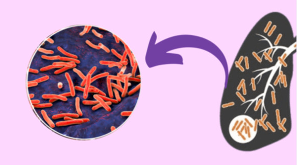 treatment for latent tuberculosis