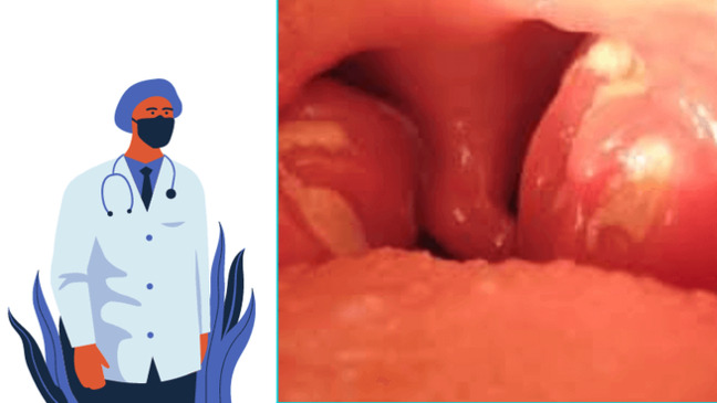 treatment of infectious mononucleosis