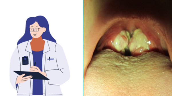 treatment of infectious mononucleosis