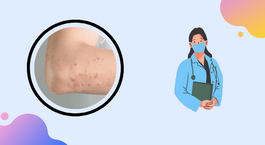 west nile virus rash