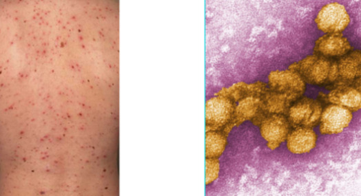 west nile virus rash