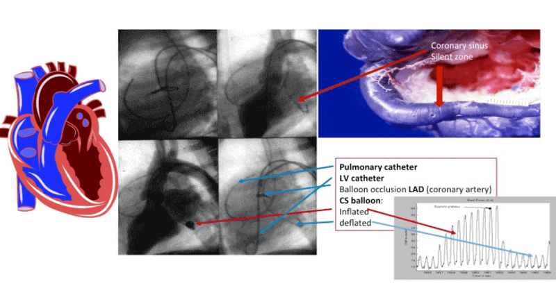 what is coronary sinus