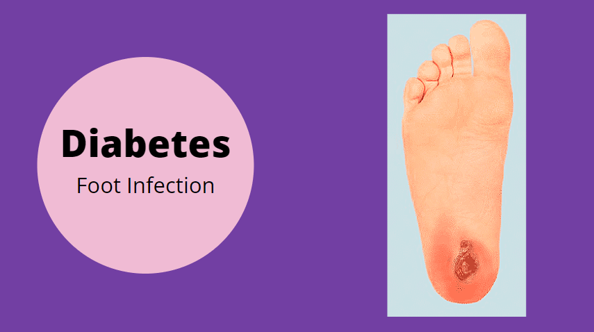 foot infection with diabetes
