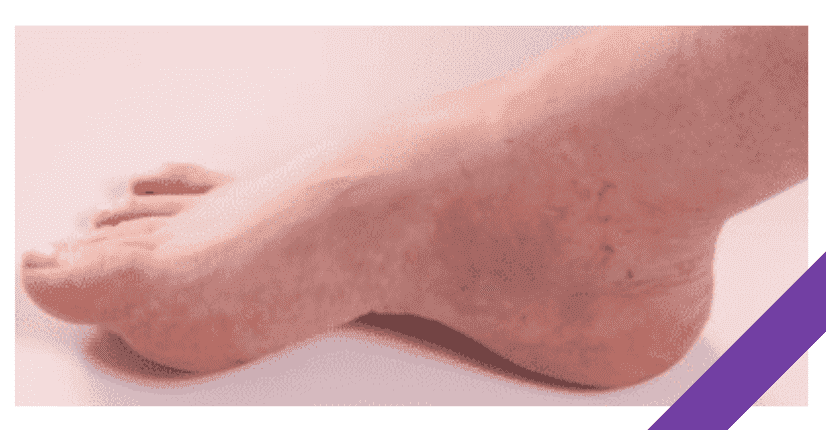 foot infection with diabetes