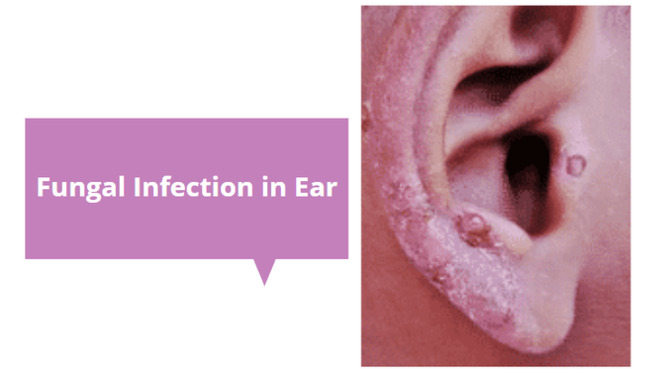 fungal infection in ear canal