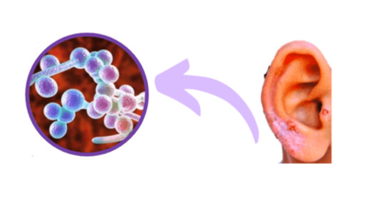 fungal infection in ear