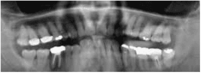 infection in jaw bone from tooth