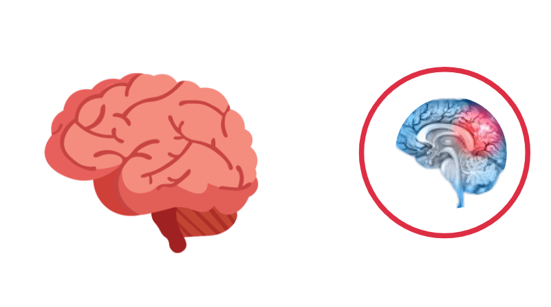 treatment for blood clot in brain