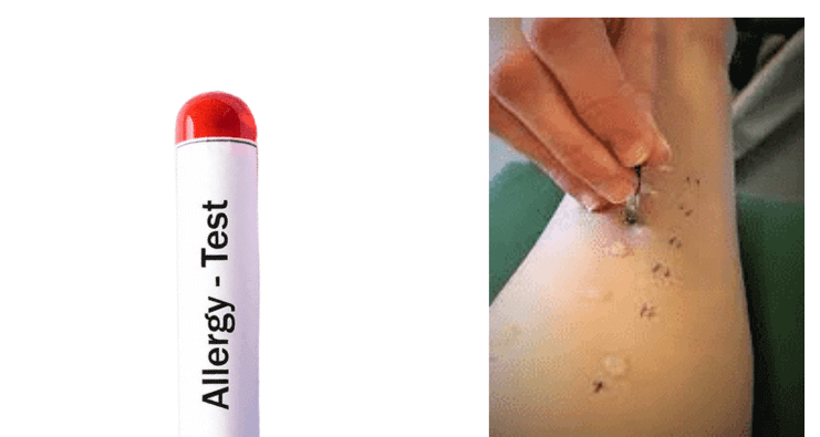 allergy tests near me