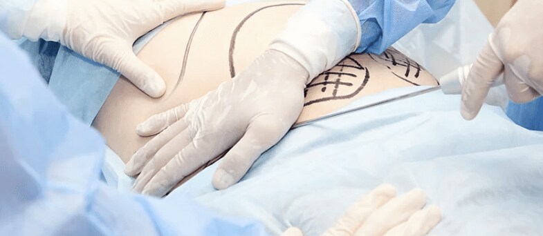 benefits of liposuction