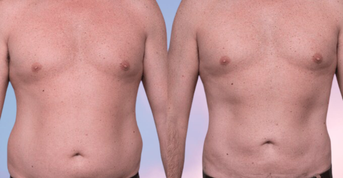 benefits of liposuction