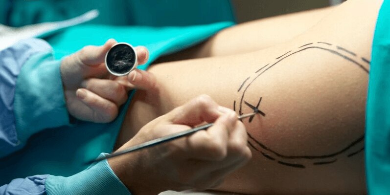 benefits of liposuction