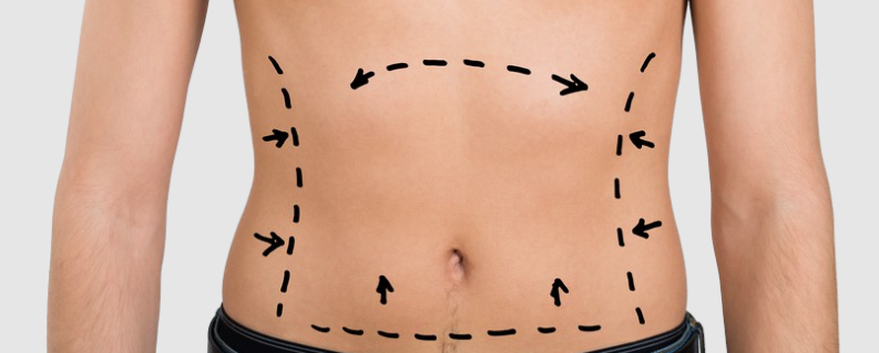 benefits of liposuction