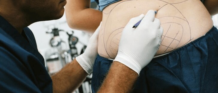 benefits of liposuction