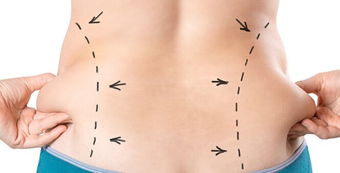 benefits of liposuction