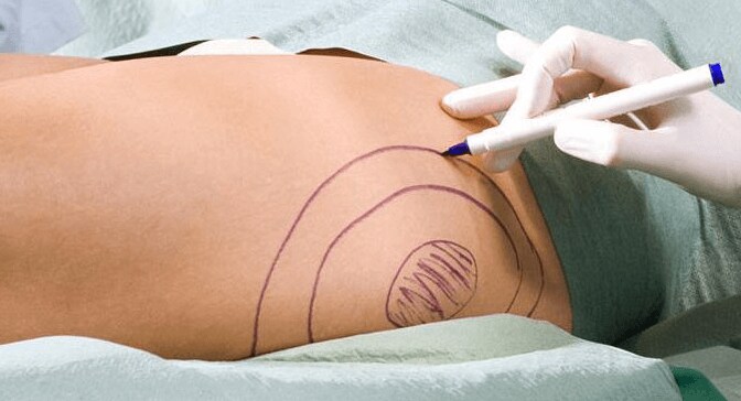 benefits of liposuction