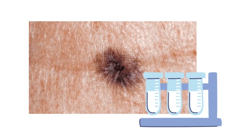 skin cancer moles early stages