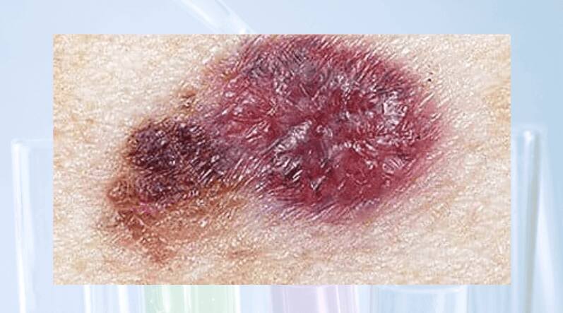 skin cancer moles early stages