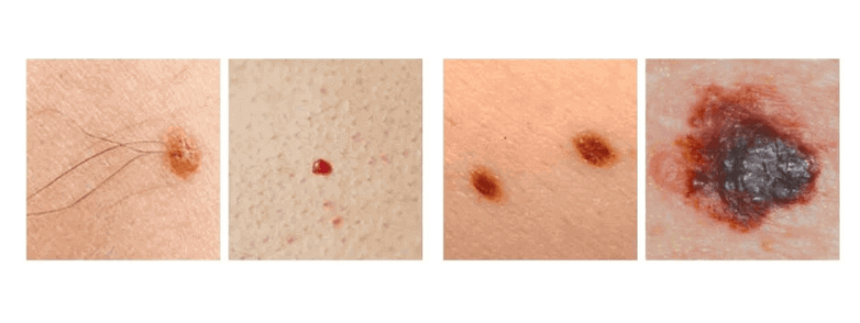 skin cancer moles early stages
