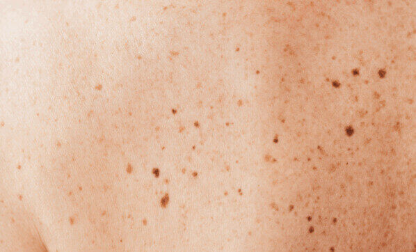 skin cancer moles early stages