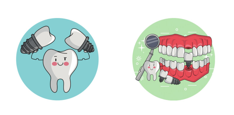 dental implants