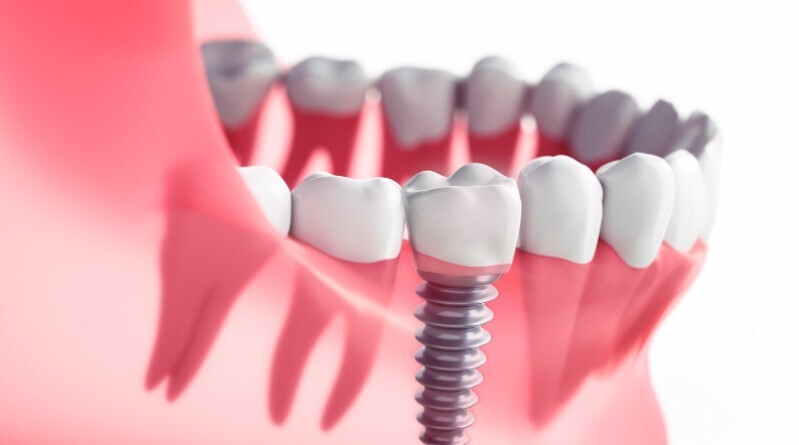 dental implants