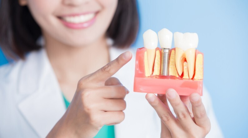 dental implants