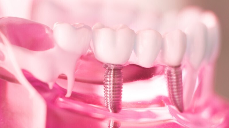 dental implants
