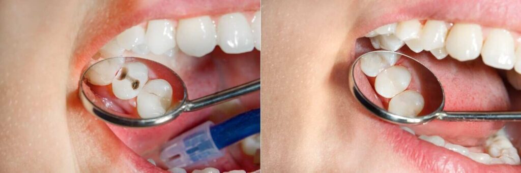 Dental Crowns Or Filling