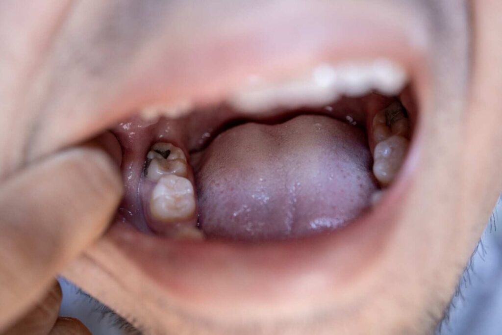 Tooth Decay