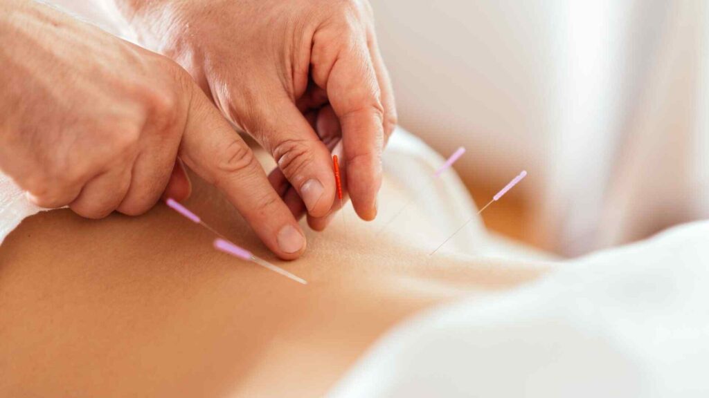 Acupuncture