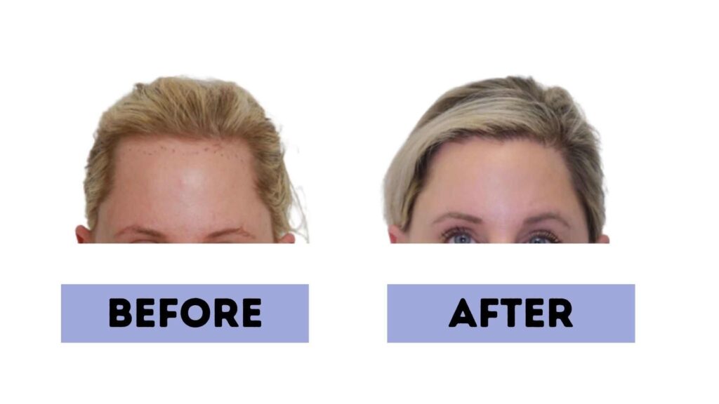 forehead reduction surgery cost