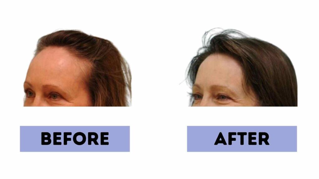 forehead reduction surgery cost