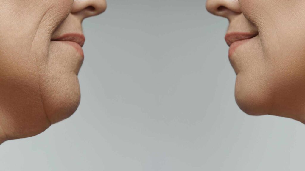 Facelifts