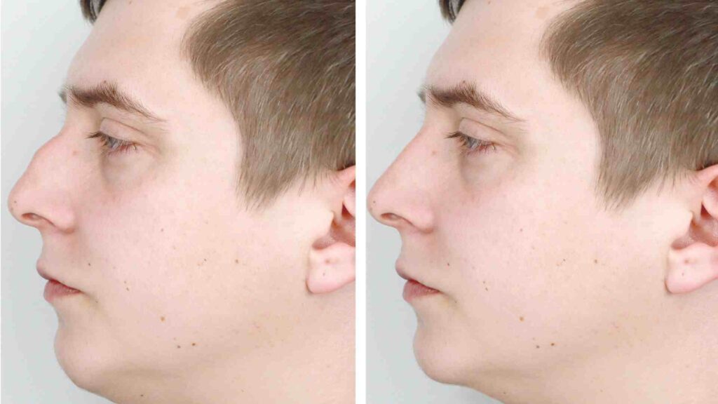 Rhinoplasty
