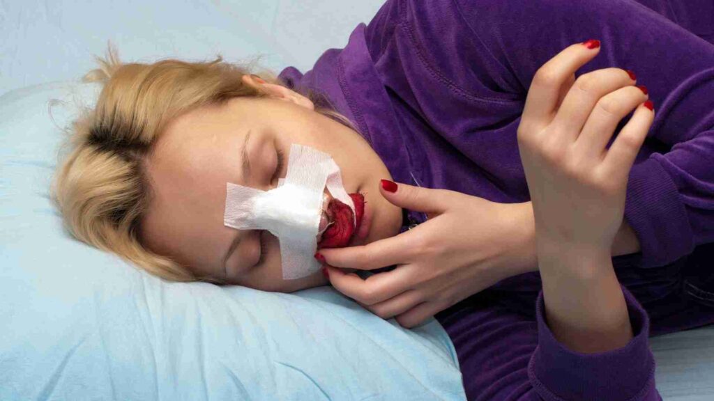 Rhinoplasty
