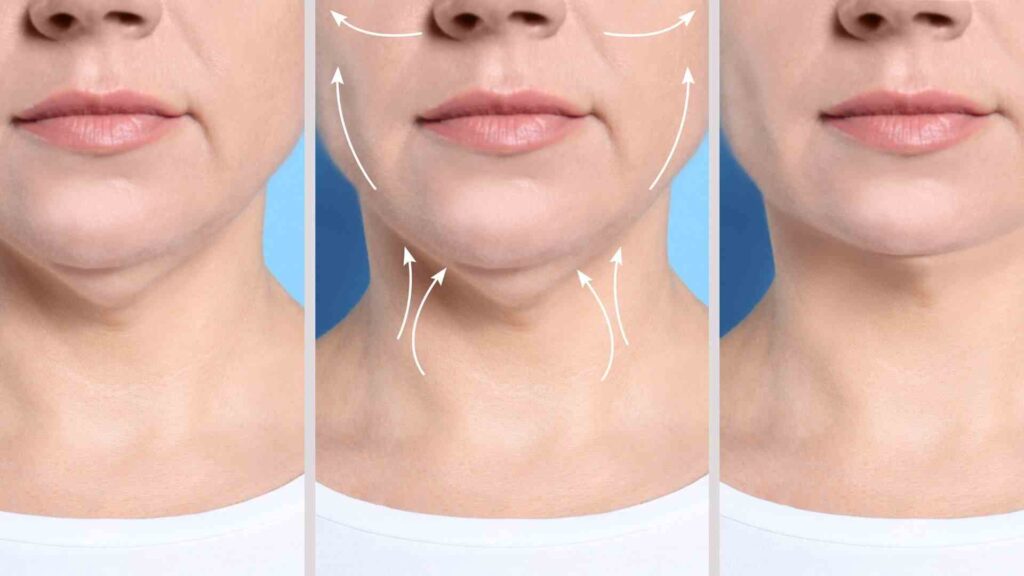 Neck Lift