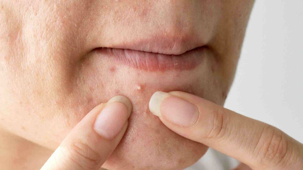 Skin Disorders