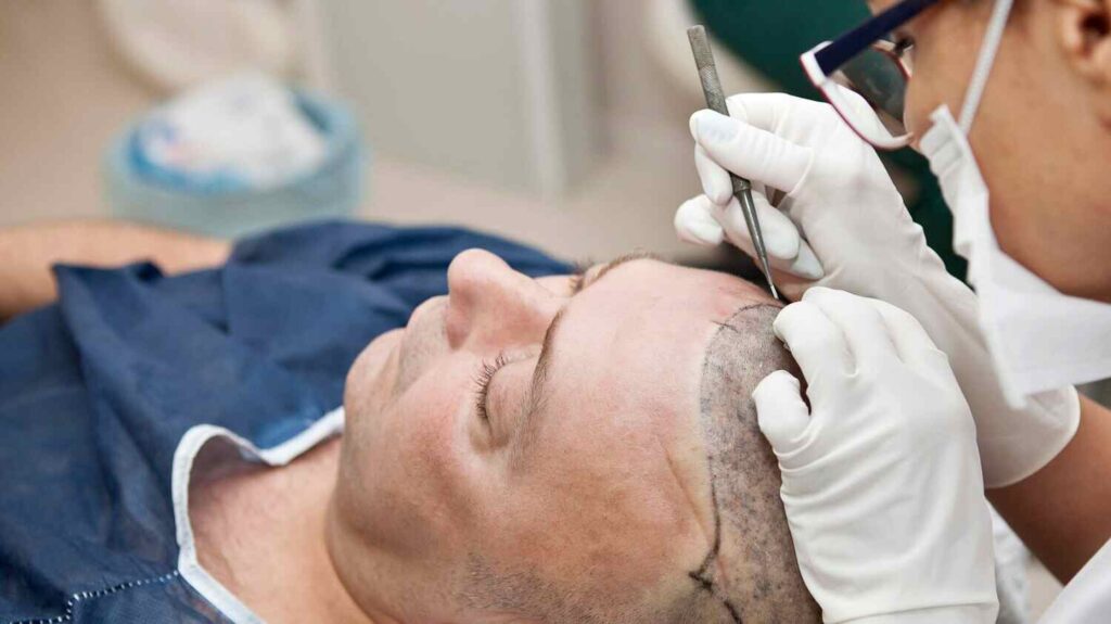 Hair Transplant