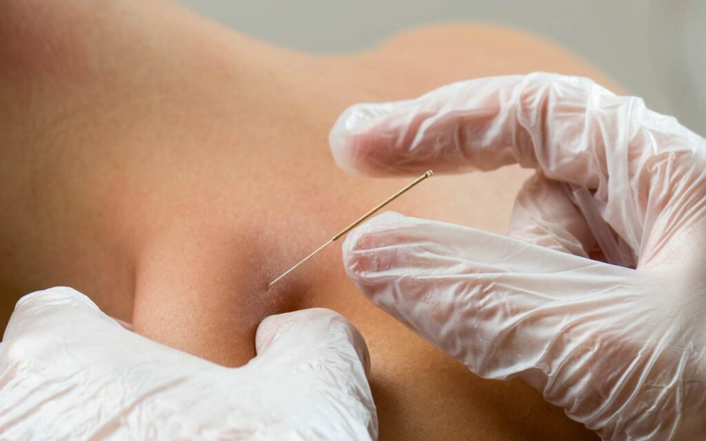 Trigger Point Dry Needling