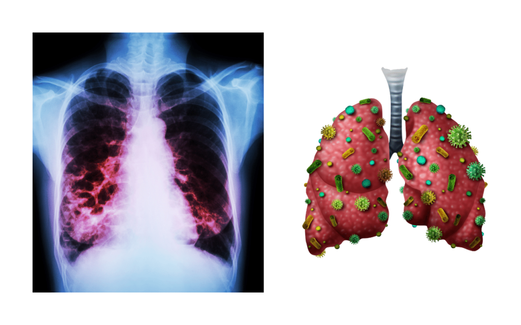 Acute Bronchitis